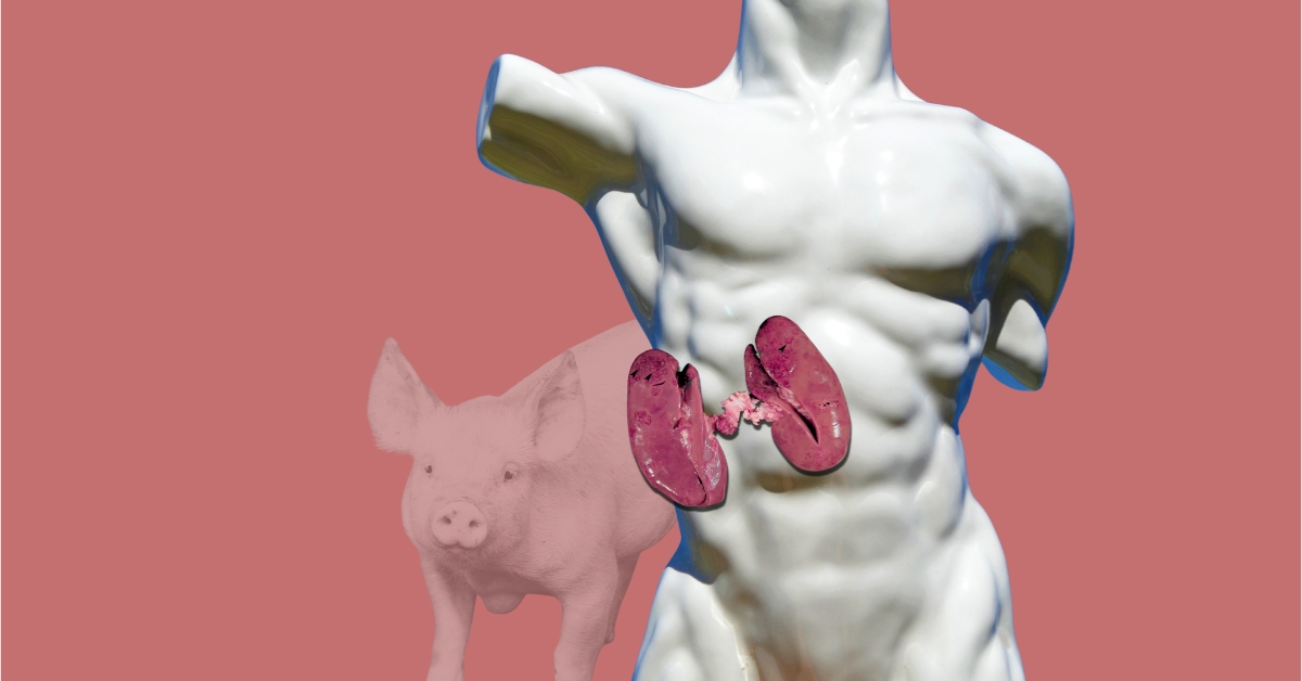 Medicine rewrites the rules as science puts a pig kidney into a human being